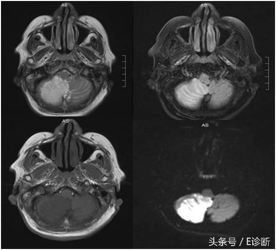 E诊断：脑梗塞影像图解