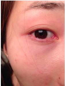 眼睛里有血丝吃什么药能消除,眼睛有血丝而且还模糊怎么消除