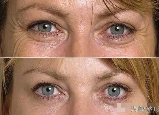 注射微整形需要了解哪些知识呢,注射美容和微整形有什么区别