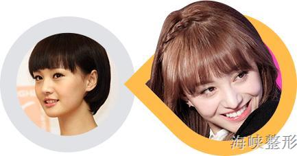 玻尿酸丰脸颊亲身经历,玻尿酸丰太阳穴脸变大了