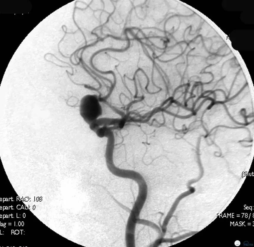 床突旁动脉瘤的血管内治疗