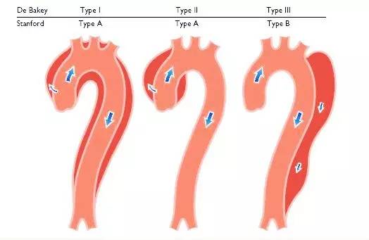 怎样防主动脉夹层,主动脉夹层一定立即要命吗