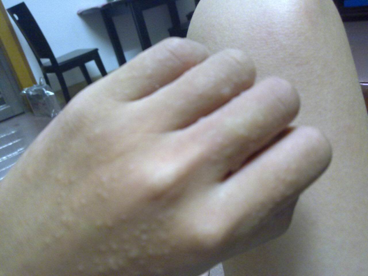 手上奇痒无比的小水泡,手上起小水泡痒用什么药