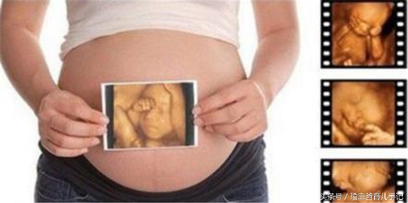 怀孕八个月胎儿心脏间隔缺损,胎儿肾盂分离需要引产吗