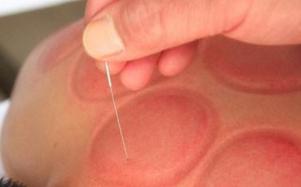 女性脸上痘痘怎么调理好得快,一个地方反复长痘如何处理