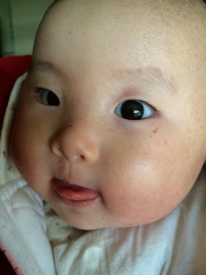 婴儿湿疹一定要保湿吗,婴儿湿疹严重要用激素吗