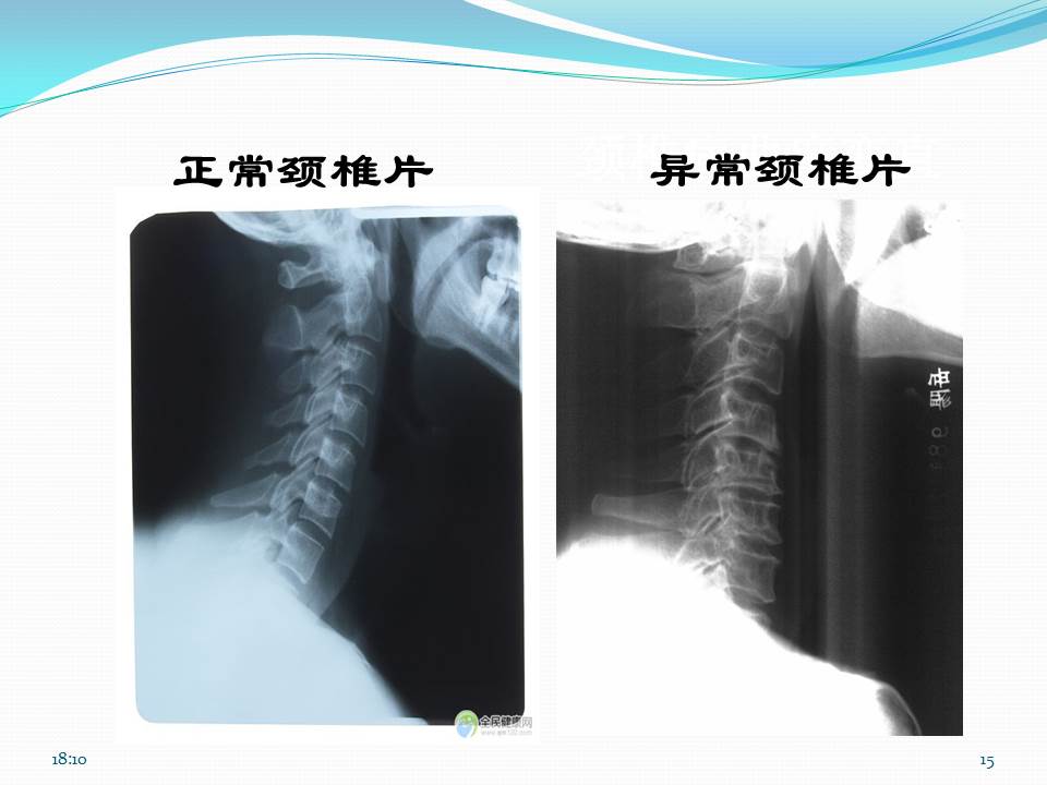 谈骨论筋颈椎病,中医治疗颈椎病名医