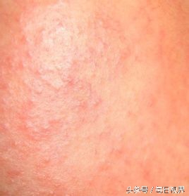 春季眼睛过敏发痒怎么办,春季皮肤过敏是什么原因