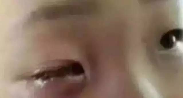 食品干燥剂炸伤小孩眼睛,食品干燥剂8岁男童