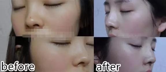 埋线隆鼻和假体隆鼻,鼻梁塌又不想做手术怎么办