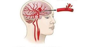 出现脑出血应该注意怎么抢救,脑溢血急救方法和技巧