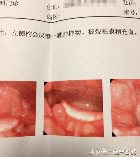 咽喉有囊肿会感觉有异物感吗,甲状腺囊肿喉咙异物感