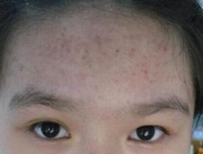 额头都是闭口痘痘怎么办,额头硬硬的痘痘怎么去掉