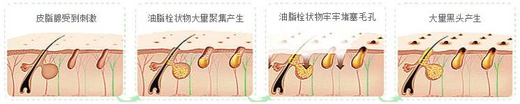 第一次刷酸去黑头新手教程,黑头处理工具用法