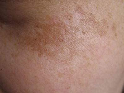 你受过妊娠斑的困扰吗图片,医生科普治疗妊娠斑