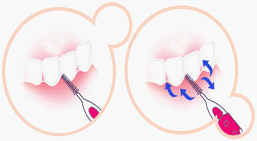 白酒治疗牙周炎的偏方怎么使用,牙周炎反复脓肿也不疼有什么偏方