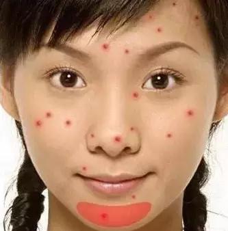 各个地方长痘的原因以及解决方法,长痘到底是什么病啊