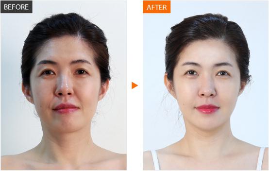 法令纹玻尿酸填充多久能洗脸化妆,法令纹填充玻尿酸会越填越深吗