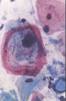 上火“走嘴”别轻视，其实是病毒感染
