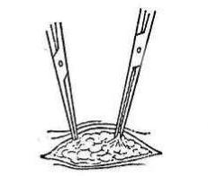 女性结扎恢复的手术过程,女性结扎的手术流程