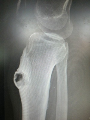 关于足球运动中胫骨骨膜炎的诊断与治疗