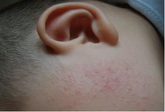 宝宝湿疹奶癣怎么消除,婴儿湿疹奶癣擦什么药膏