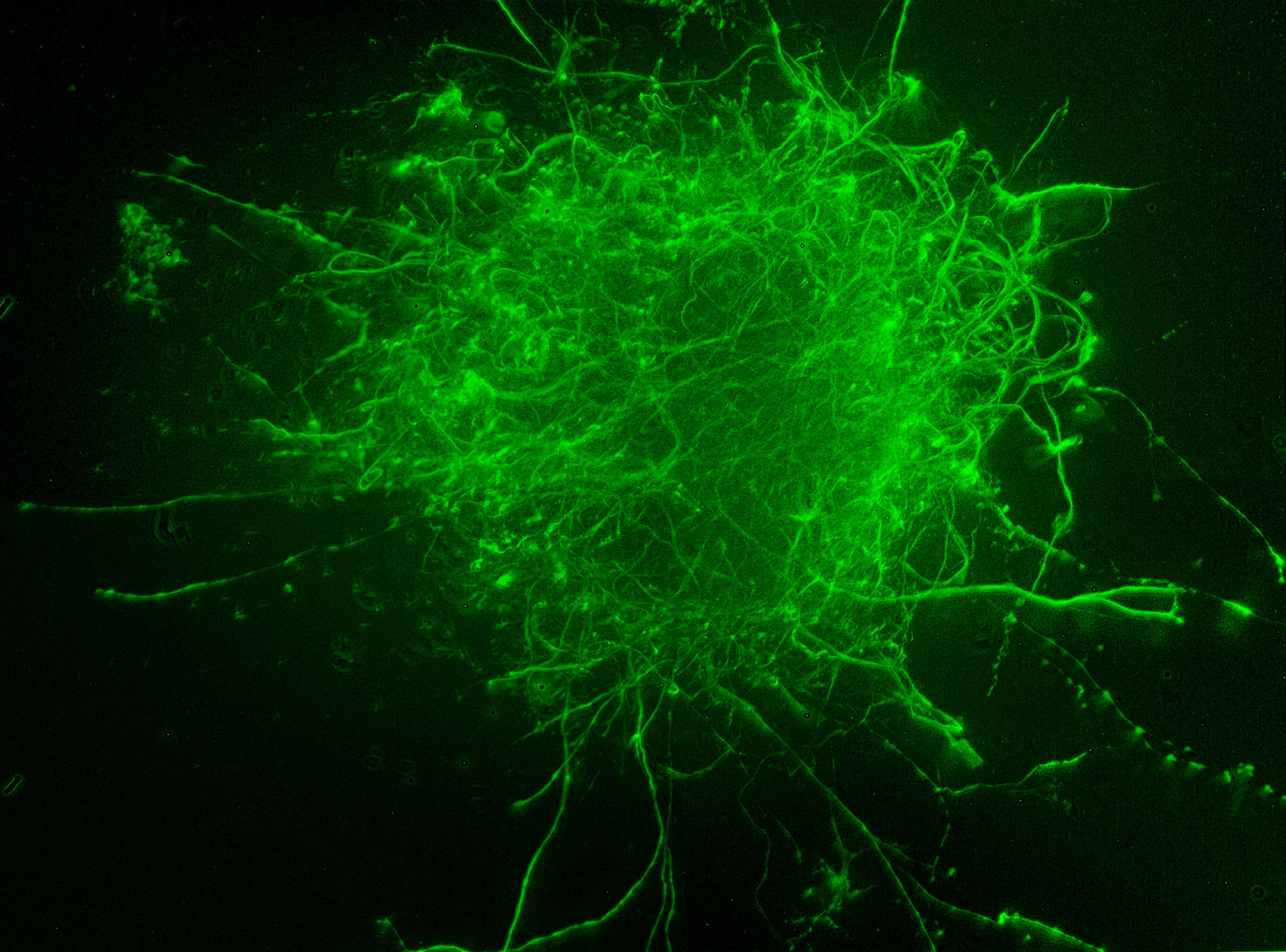 人羊膜上皮干细胞移植治疗帕金森,帕金森叠加综合征与干细胞移植