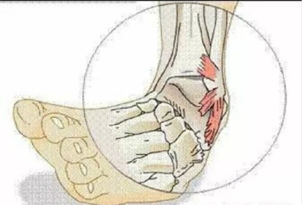 足球运动中踝关节扭伤如何处理,足球运动中踝关节损伤原因