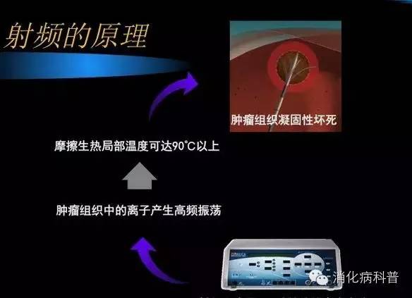 肝癌做射频消融术医保报销多少钱,肝癌射频消融手术后多久能吃中药