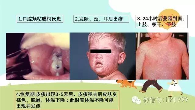 儿童麻疹症状及处理方法,小儿麻疹的症状和注意事项