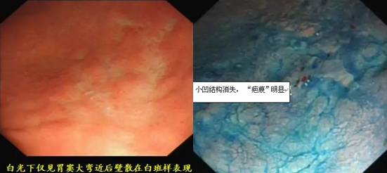 精细胃镜检查（二）——色素内镜（上）