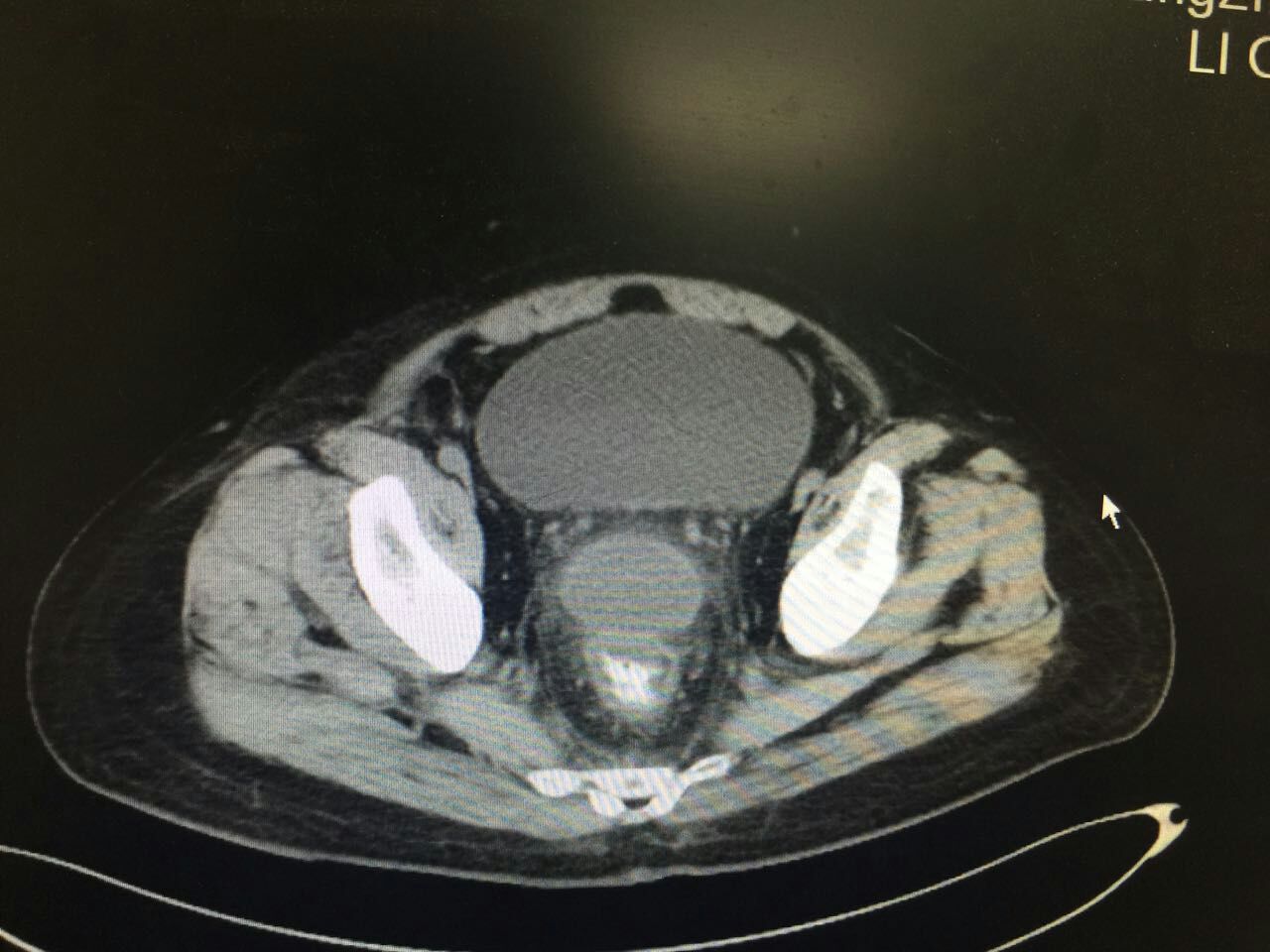 阑尾术后大便稀正常吗,阑尾术后一周大便出血