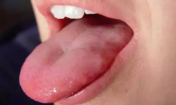 湿气重除湿最好的方法,湿气重可以用什么方法除湿最佳