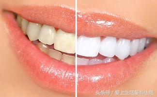 无需洗牙5分钟消除牙垢,不洗牙去除牙垢的实用方法