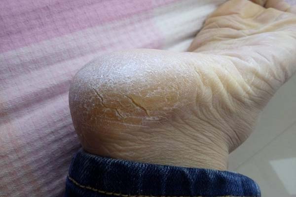 手脱皮干裂用什么中药治疗,治脚气脱皮干裂的中药配方