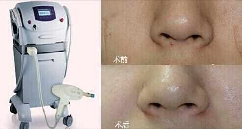 马油祛疤痕吗,马油真的可以去鸡皮肤吗