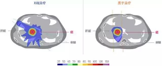 肝癌质子治疗,质子治疗对肝癌的要求