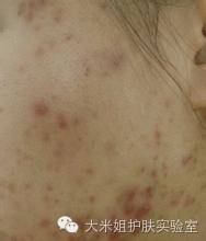 美白祛斑真的有科学依据吗,美白祛斑的原理