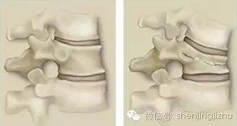 骨质疏松会导致脊柱压缩性骨折吗,骨质疏松脊柱压缩骨折治疗方法