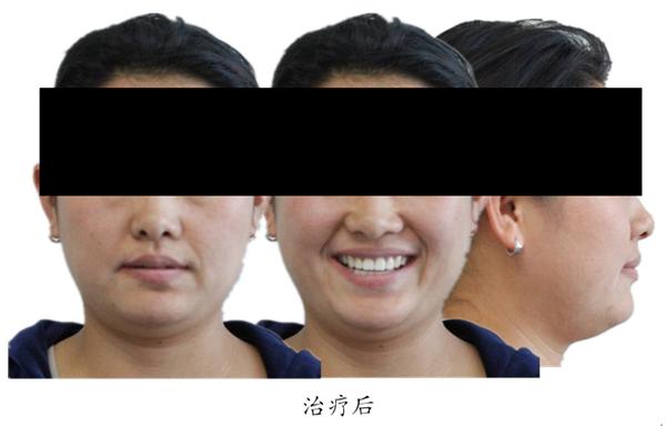 拔牙有风险拔牙需谨慎,拔牙后果严重吗