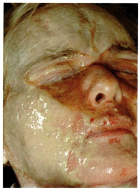 果酸换肤方法,果酸换肤让皮肤焕然一新