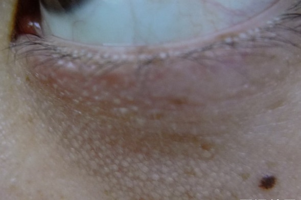 眼睛上有个小颗粒是什么,眼睛上的脂肪粒叫什么