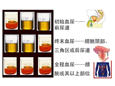 医生验尿结果大吃一惊,尿三杯试验的报告