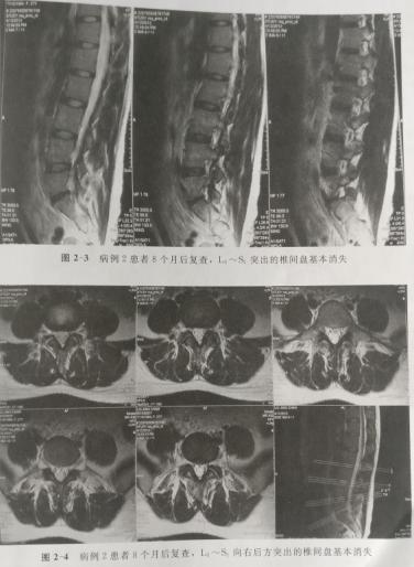 腰椎间盘突出可以练瑜伽吗,腰椎间盘突出可以做什么运动
