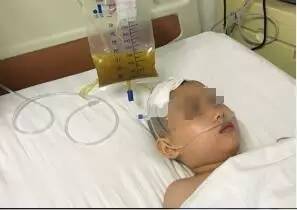 周忠清颅咽管瘤全切的终身复发率,周忠清谈颅咽管瘤术后寿命