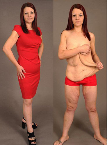 过快减肥的坏处,过快减肥导致脾大