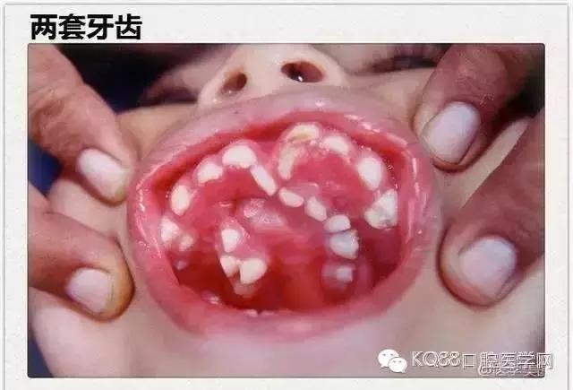 揭秘孩子是如何长出两层牙齿的？