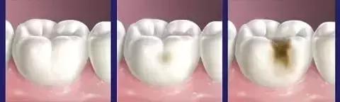 蛀牙怎样才能控制住不再有蛀牙,蛀牙怎么避免更严重