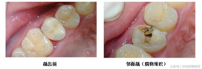 吃肉就塞牙怎么彻底解决,吃肉塞牙有什么好的办法解决