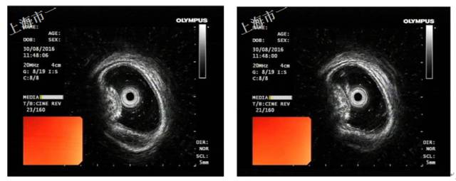 直肠有哪几种情况需要手术,直肠病变esd手术指南